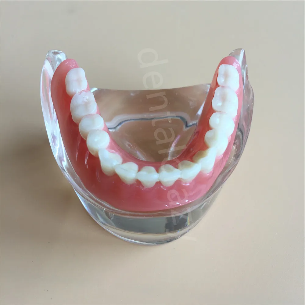 Стоматологическая модель зубов с 4 имплантатом сверхпротез низшая демонстрационная модель исследования зубов 6002