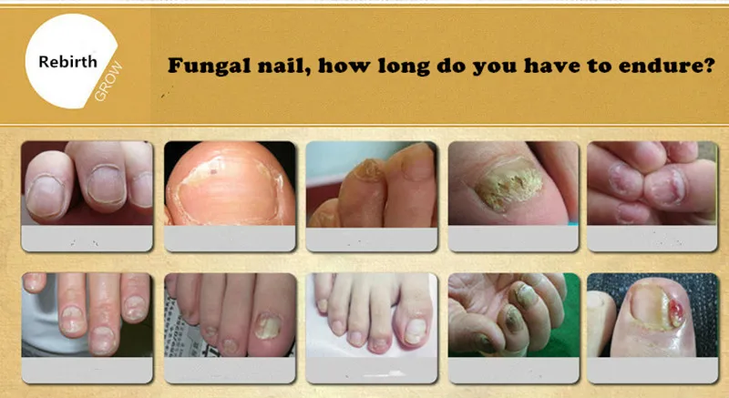 Dimollaure средство для лечения грибка ногтей, средство для ухода за ногами, забота о здоровье ног, против грибка, для удаления инфекций, гель для ногтей, Paronychia