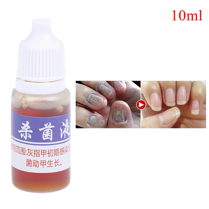 

1Pc Anti Infection Paronychia Onychomycosis Fungal Nail Treatment Feet Care Essence Foot Whitening Toenail Fungus Removal