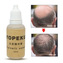 YOPEKU имбирное масло для роста волос растительное эфирное масло быстрее рост волос шампунь лечение повреждения анти выпадение волос жидкость 20 мл