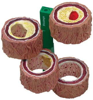 

Atherosclerosis with vascular thrombosis process model Thrombosis model Vascular model