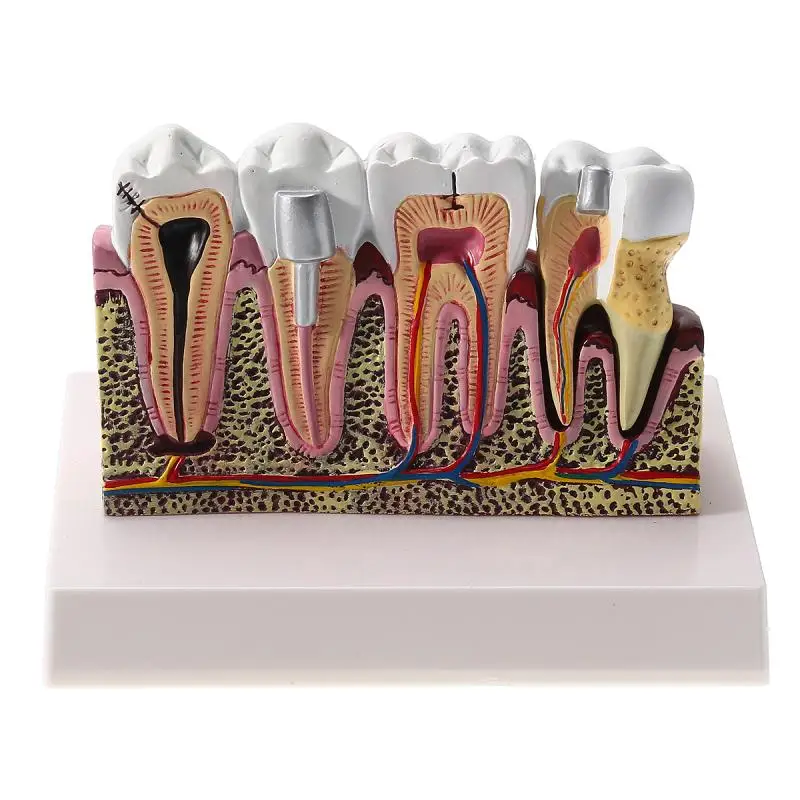 

Anatomical Teeth Common Pathologies Model Detachable Dental Oral Caries Demonstration For Medical Science Teaching Communication