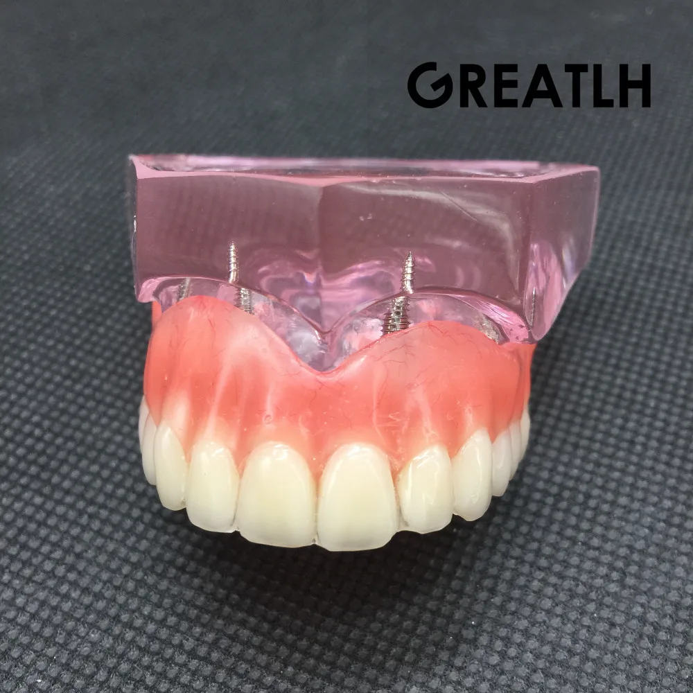 Dental Overdenture Superior with 4 Implants Demo Model Dental Teaching Study Demonstrate Model #6001 01 цена Dental Overdenture Superior with 4 Implants Demo Model Dental Teaching Study Demonstrate Model #6001 01 цены онлайн