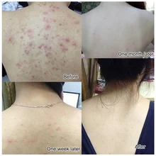 Лучшее море мыло с солью прыщи, акне лечение козы увлажняющее молочко мыло для очистки лица QQ99