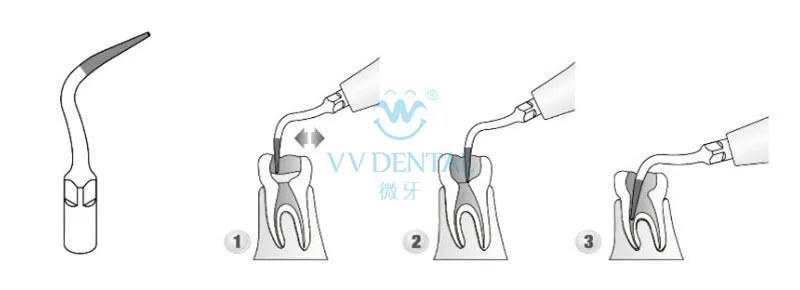 Стоматологический Скейлер Endodontics Kit SEKS Серебряный Стоматологический материал из нержавеющей стали стоматологическое оборудование для DTE продуктов odontology