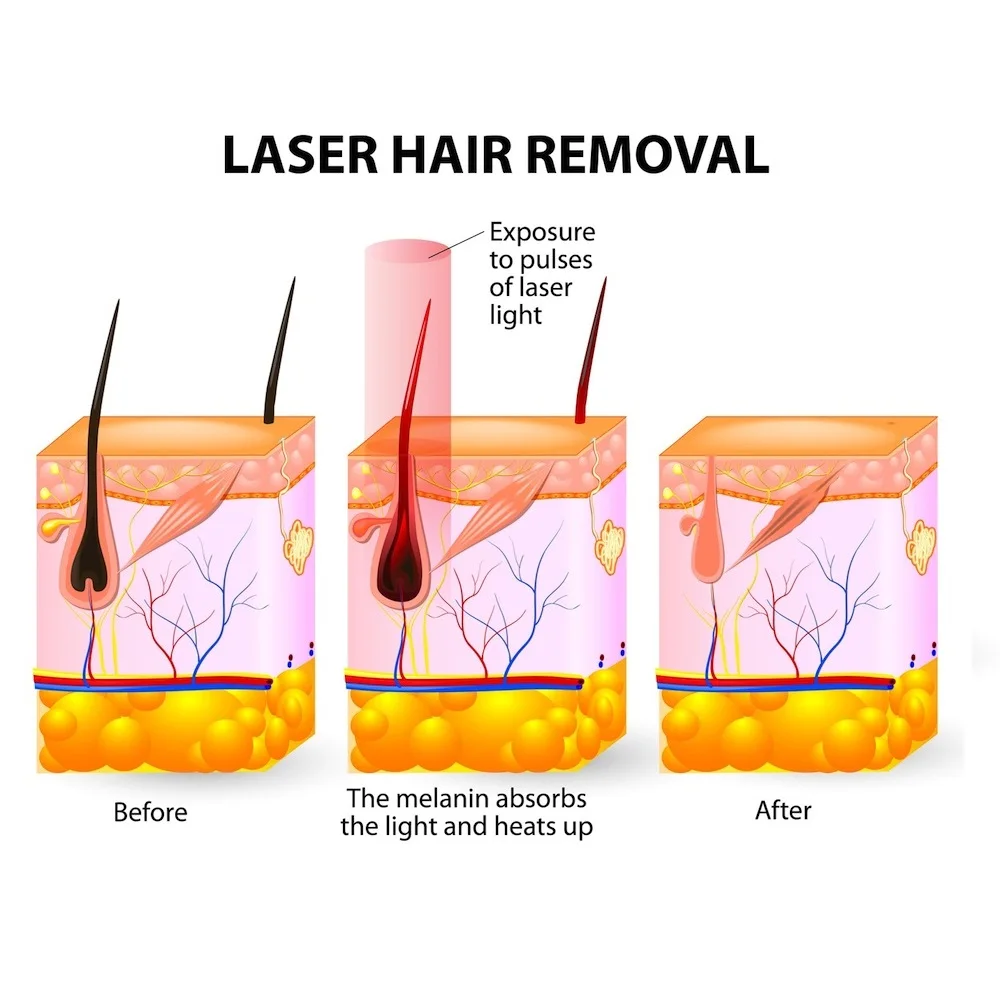 Laser-hair-removal