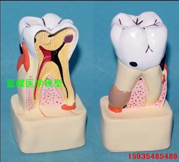 Зубной полости модель стоматологических заболеваний комплексное патологическая Модель Стоматологическая Анатомия профиль модель зубной