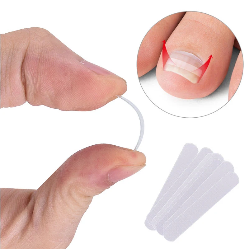 10pcs Professional Ingrown Toe Nail Correction Pedicure Straightening Clip Toenails Protector Elastic Patches Toenail Treatment