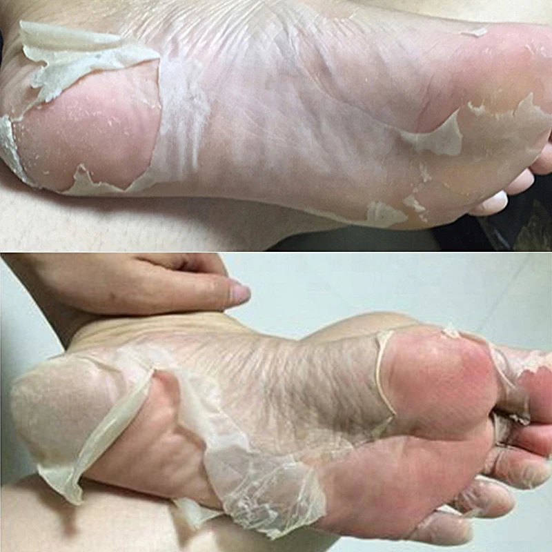 baby foot skin