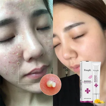

1PCS RtopR Mango Remover Acne Cream Facial Acne Blackheads Treatment Improves Facial Skin Pores Whitening Skin Care TSLM2