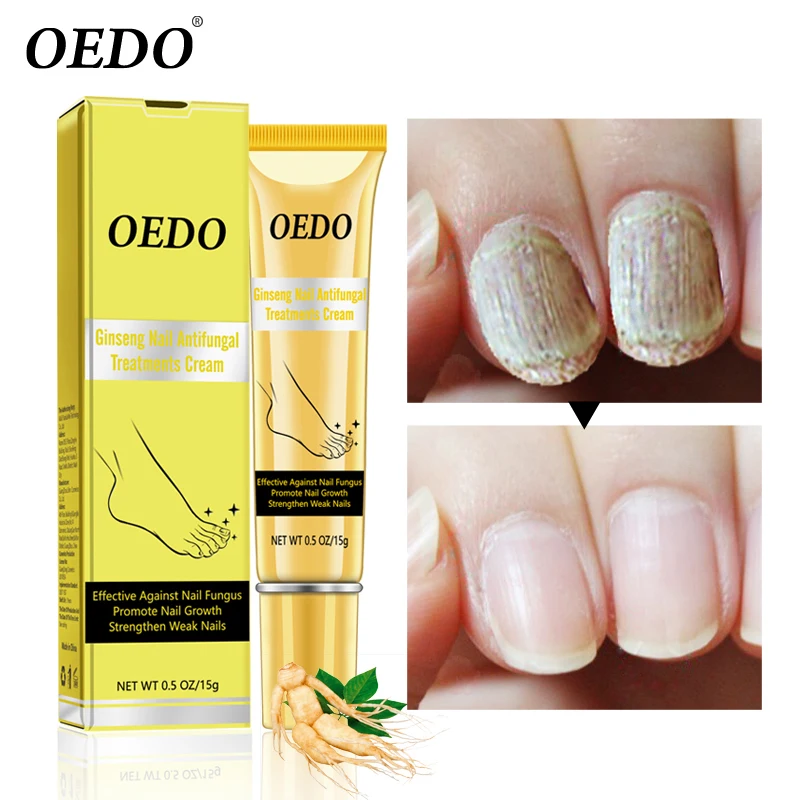 Ginseng Nail Antifungal Treatments Cream Herbal Removal Nail Fungus Toe