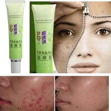 Acne Remove Cream Remover Vanishing Pimples Spot Black Head Treatment Cream