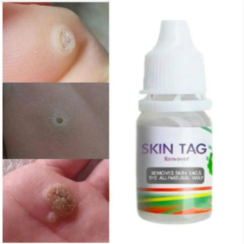 Body Warts Treatment Wart Cream Skin Tag Remover Foot Corn Removal Plantar Genital Warts Ointment Shoe Accessories Dropshopping