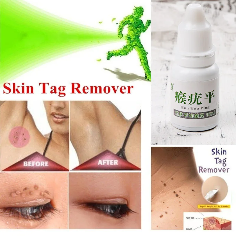 

Skin Tag Remover Cream Oil 12 hours Tu kill Medical Remover Mole & Genital Wart Remover Foot Corn Removal 10ml Send Cotton Swab