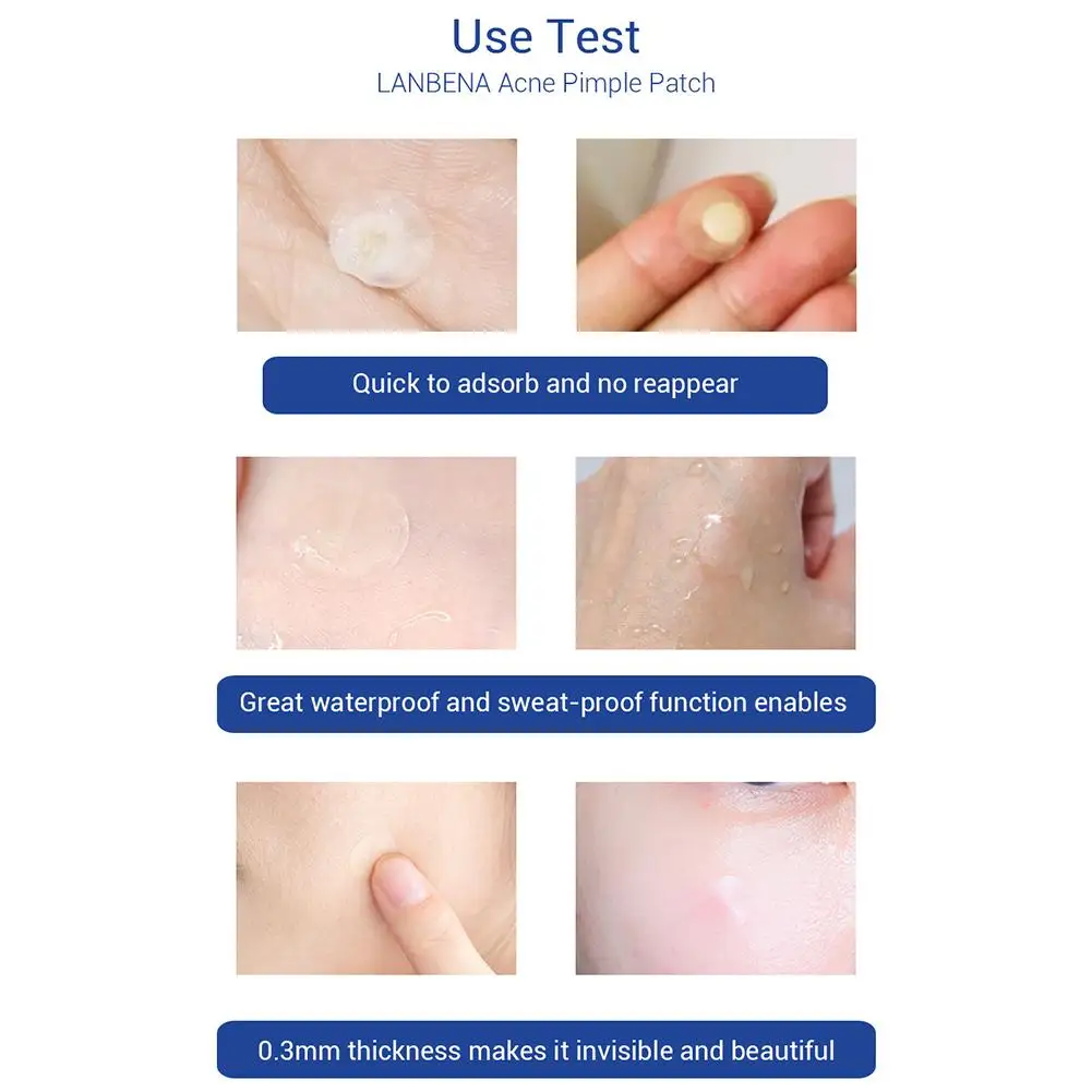 Средство против прыщей, средство против прыщей, средство для удаления прыщей, средство для удаления пятен, обернутая маска для лица, уход за
