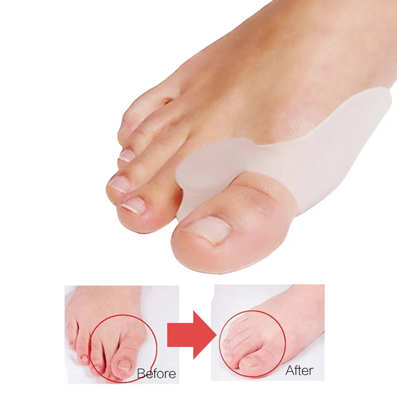 

2pair Beetle Crusher Bone Ectropion Toes Hallux Valgus Outer Appliance Technology Feet Care Silicone Toe Big Bone Foot Care