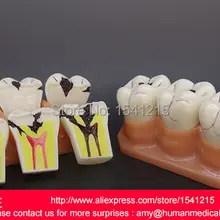 Патологическая анатомическая модель зубов кариес гингивал, 4 раза развития полости зубов MODEL-GASEN-DEN043