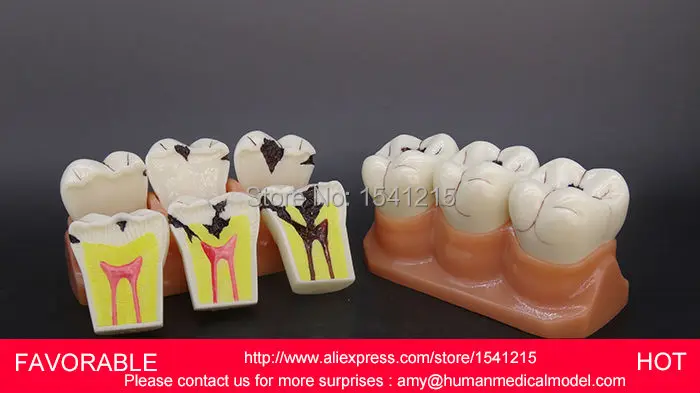 

TOOTH DISEASE PATHOLOGICAL ANATOMICAL MODEL OF TEETH CARIES GINGIVAL,4 TIMES THE TOOTH CAVITY DEVELOPMENT MODEL-GASEN-DEN043