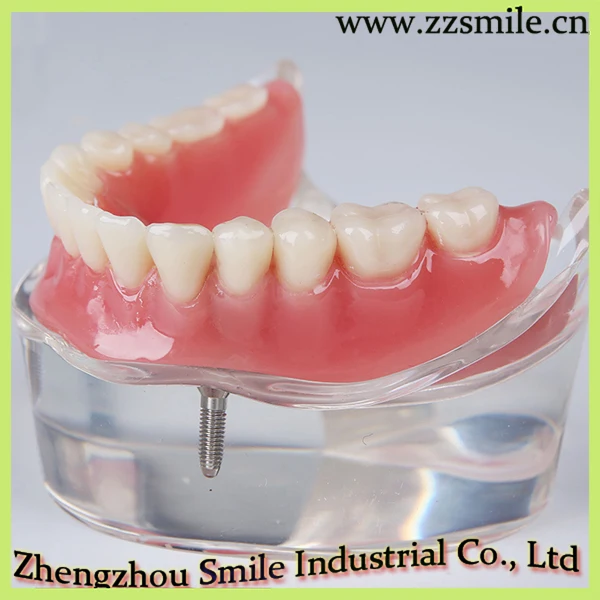 Стоматологический нижний протез уступает с 2 имплантатами/стоматологическая демонстрационная модель зубов M6002