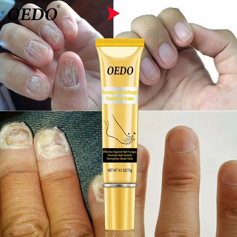 15g Ginseng Nail Treatments Cream Natural Herbal Removal Nail Fungus Anti Infection Nail Care Cream