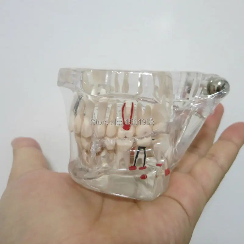  Dental materials denture model Oral removable dental pathological model Tooth Study Teach Model - 32795839251