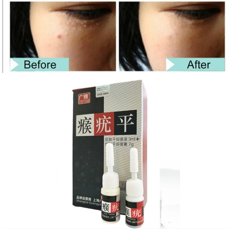 

2pcs/set Skin Tag Mole Wart Remover Eye Skin Tag Remover 12 Hours Remover Liquid