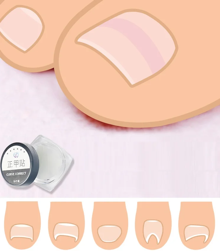 Ingrown Toenail Pedicure Tool Straightening Clip Curved Brace Toenails Thick Paronychia