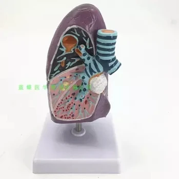 Pathological lung model The smokers' visceral lung section of the respiratory system anatomic model of kidney pathological model of kidney