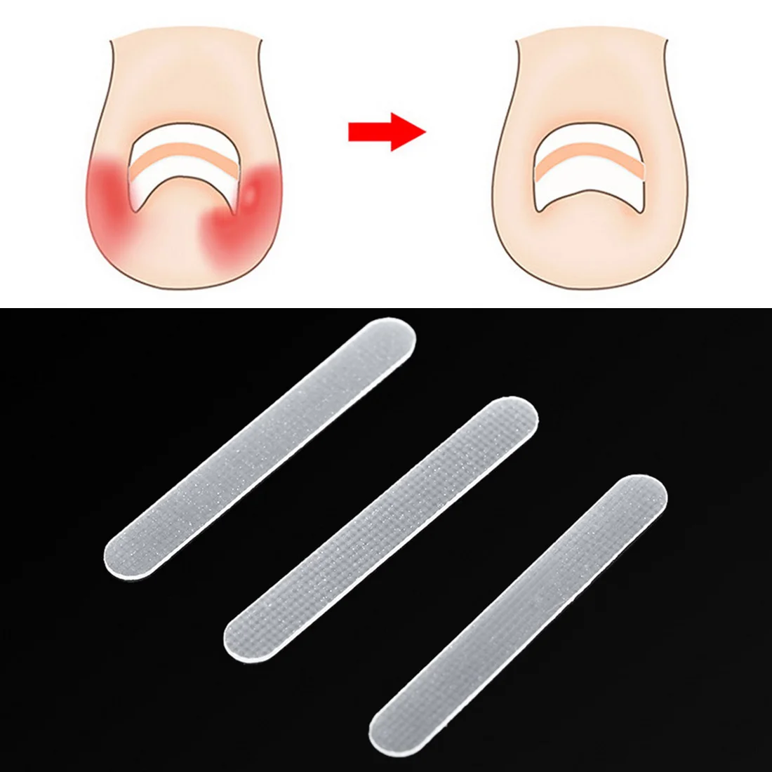 Paronychia Correction File Elastic Patch Corrector Treatment Tools 10pcs/box Toe Nail Ingrown Correction Sticker Patch Foot Care