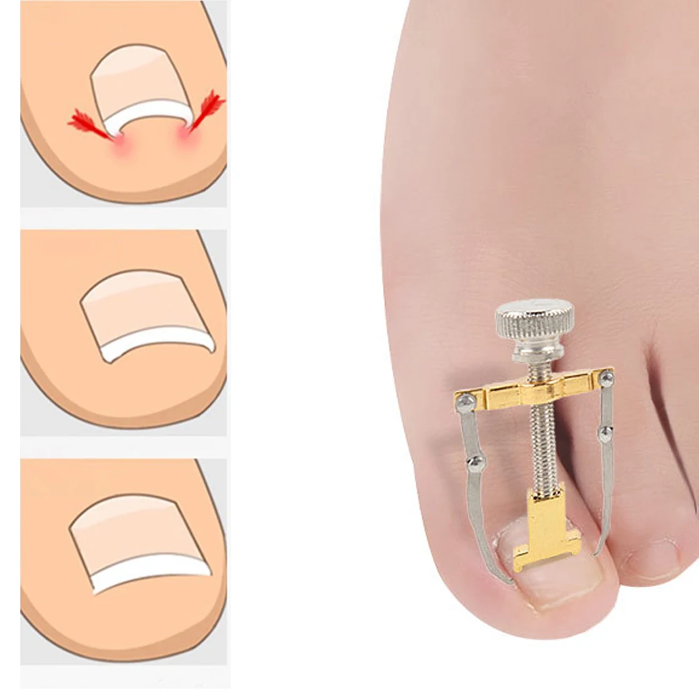 Педикюр вросший ноготь Ingrown Toe корректор для педикюра инструмент для ухода за ногами бандаж для ногтей набор машина для детоксикации Onyxis Bunion прецизионные кусачки для ног