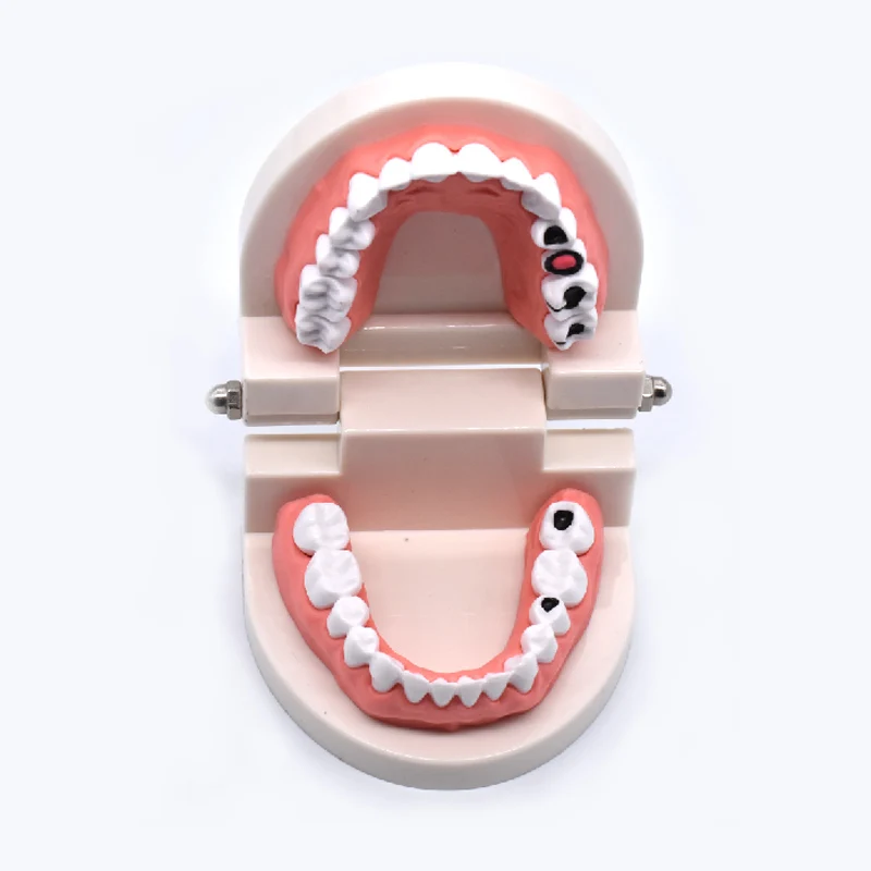 

Dental Study Teaching Teeth Model decayed tooth decay dental caries Tooth Care Education Dentist Equipment Denture