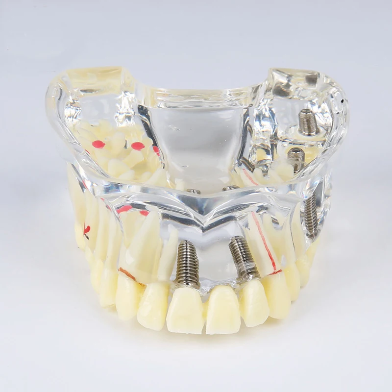 

1 Pc Dental Implant Illustration Teeth Model Detachable for Display M-2006