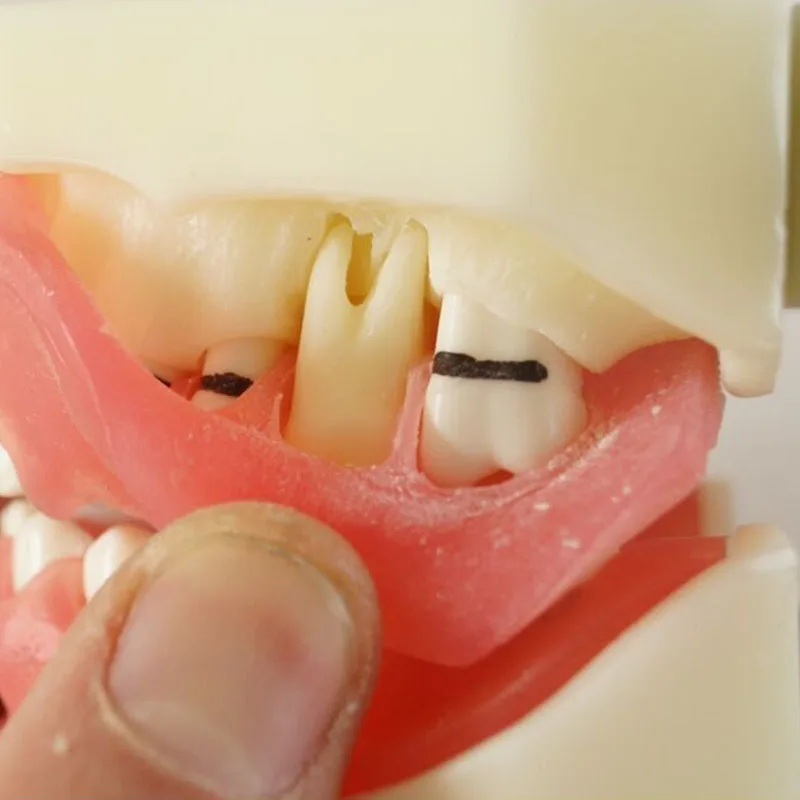 Dental Peridontal Disease Teeth Model Teeth Study Model