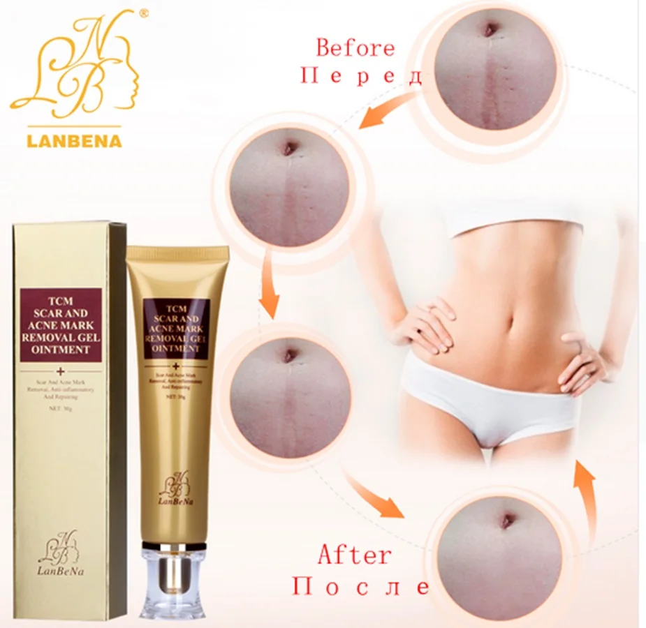 2017 New Style LANBENA Acne Scar Removal Cream Skin Repair Face Cream Acne Treatment Blackhead Whitening Cream Stretch Marks 30m c