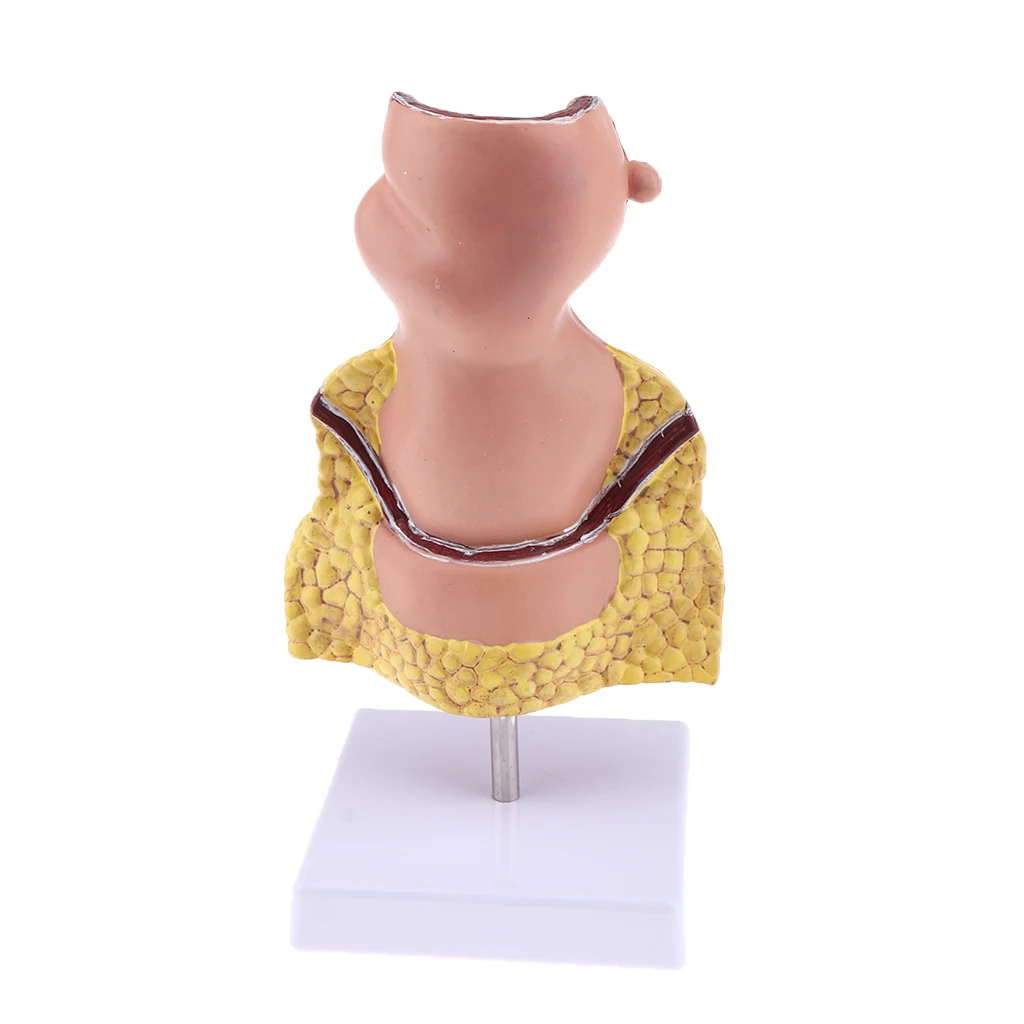 5x Pathological Rectum with Anus Hemorrhoid, Human Anatomical Model Anorectal Diseases Learning for Student Teacher Acss