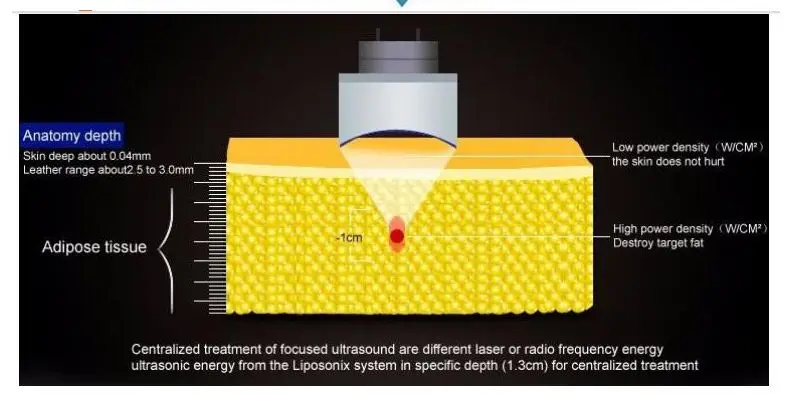 Flash Deal liposonix slimming beauty equipmeng for beauty spa 6