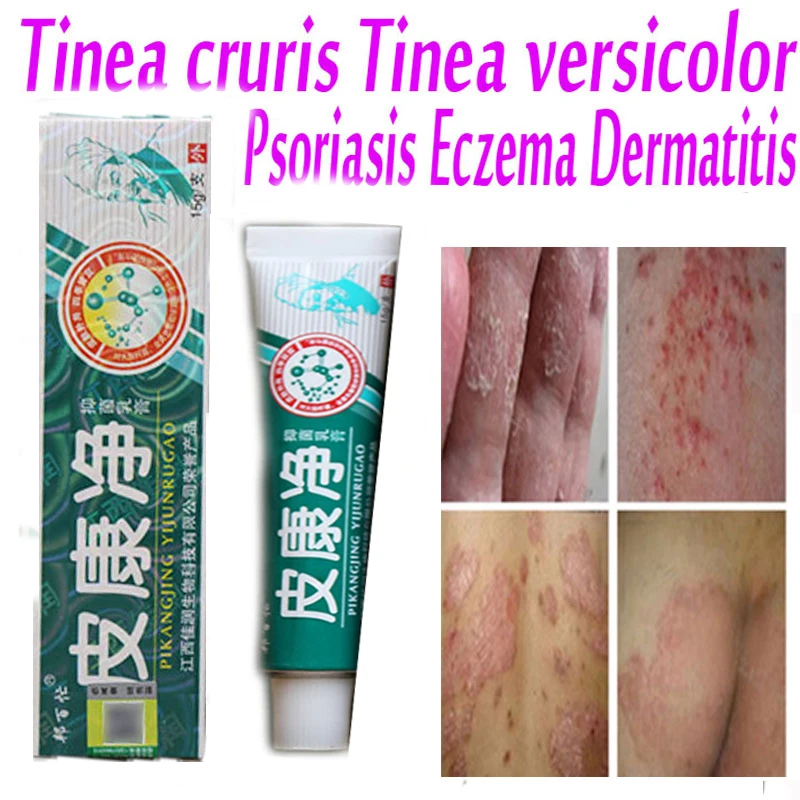 Chinese Cream for dermatitis and eczema pruritus psoriasis itching skin