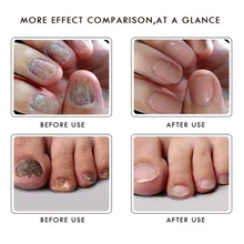 Имбирь Антибактериальный крем для восстановления эфирного масла для ногтей Питательный Уход для здоровья ногтей NShopping