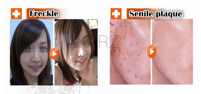 AKARZ, известный бренд, натуральная отбеливающая лицевая сыворотка, экстракт, средство для удаления эссенцепота, осветляющая сыворотка для отбеливания кожи, скраб для лица, уход за кожей