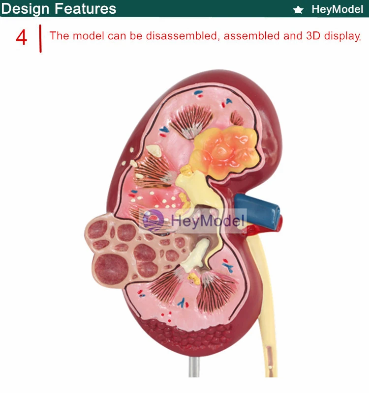 Heymodel почек поражений модель