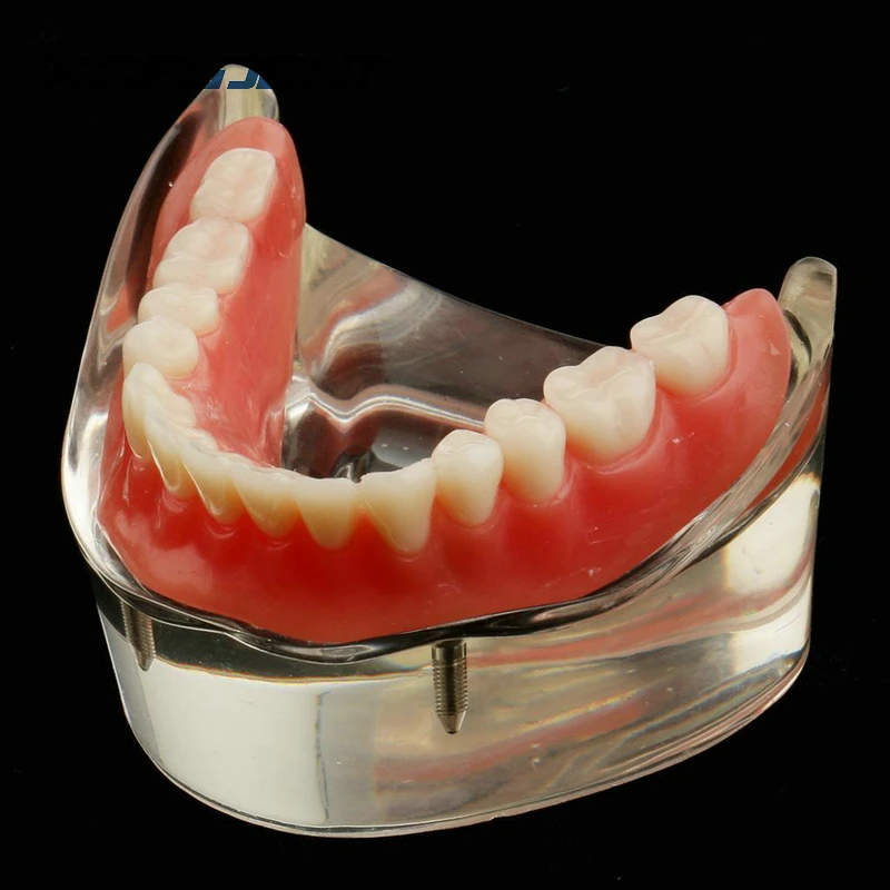 1 шт. зубная модель нижней челюсти с имплантатом реставрация зубной протез внутренняя нижняя челюсть для медицинского обучения