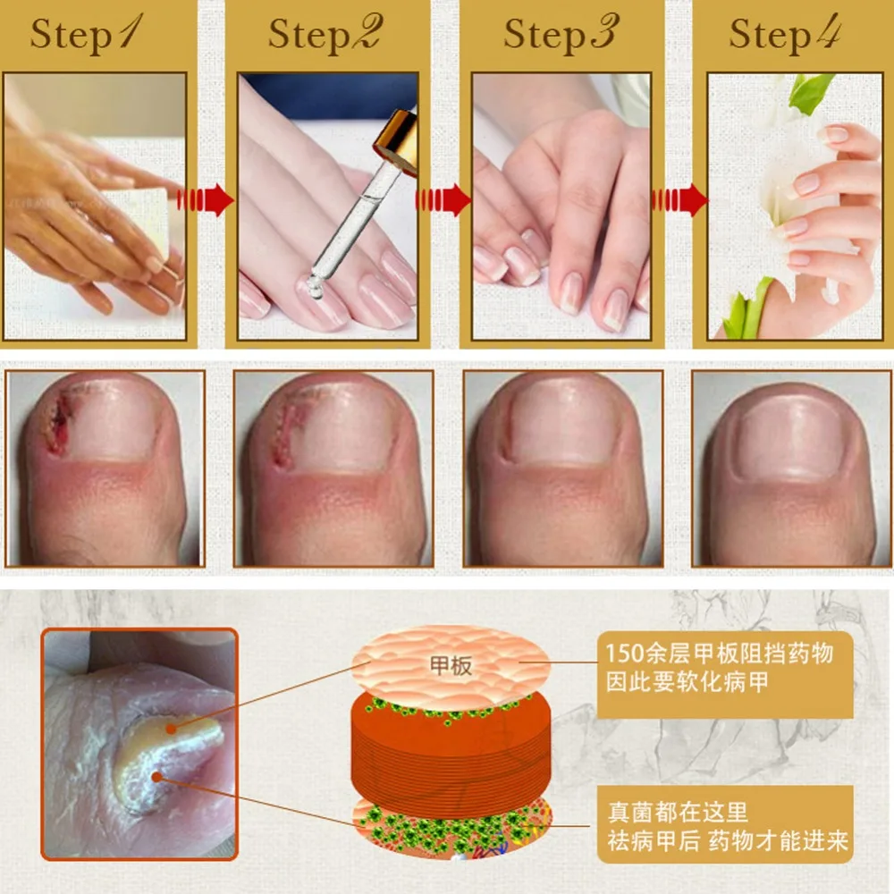 New Arrival Fungal Nail Treatment Essence Nail and Foot Whitening Toe Nail Fungus Removal Feet Care Nail