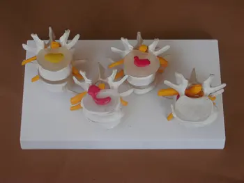 

45cm Human lumbar spine model intervertebral disc model lumbar vertebrae bone lesion model 4 pcs