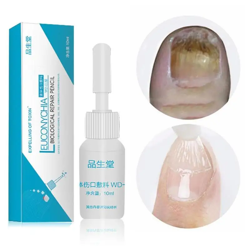 

10ml Anti Fungal Treatment Nail Pen Onychomycosis Paronychia Infection Herbal Toe Finger Nails Health Beauty Accessories