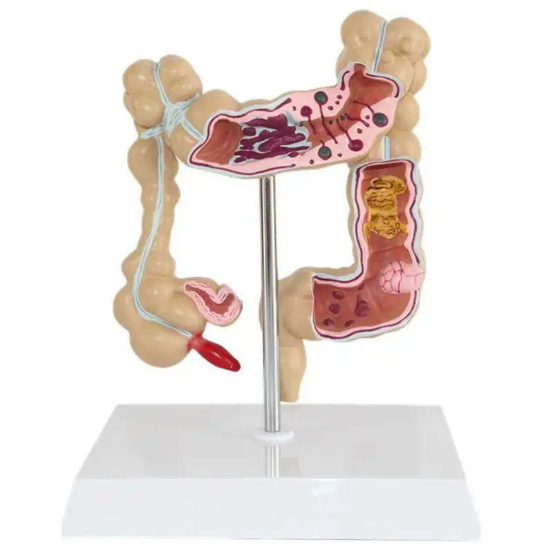 modelo de lesão colorectal cólon humano cobra grande intestino doenças patológicas modelo médico organizador anatomia