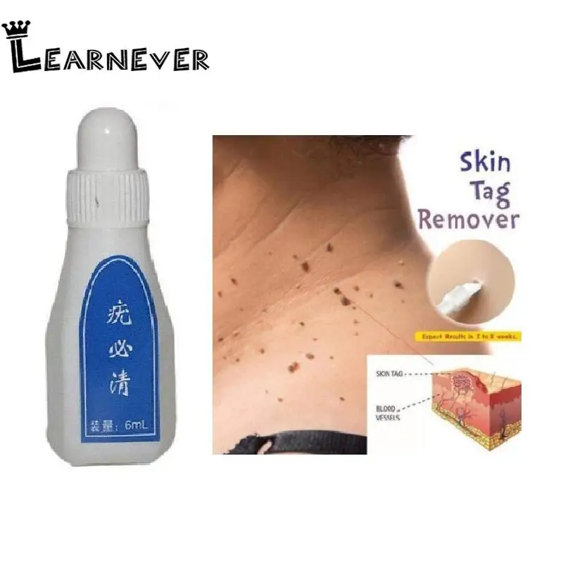 

Dropshipping Skin Tag Remover 12 hours Tu kill Medical Tu kill Remover Skin Tag Mole & Genital Wart Remover