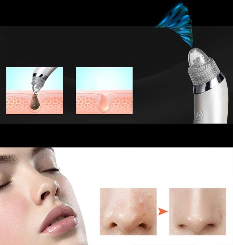 blackhead9888 (4)