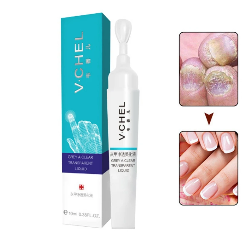 

Herbal Toe Nail Fungus Treatment Nail Treatment Pen Onychomycosis Paronychia Anti Fungal Nail Infection