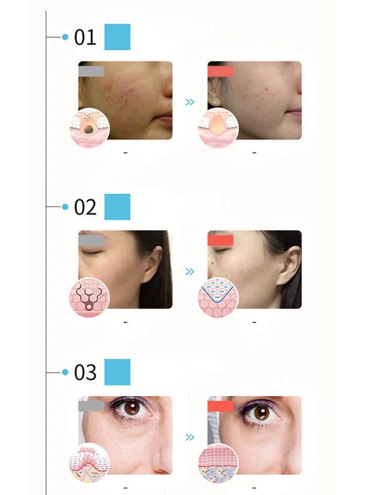 Светодиодная фотоновая маска Pdt для лица, терапия по омоложению кожи, устройство для спа-удаления акне, против морщин, BeautyTreatment Foreverlili