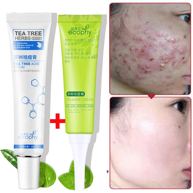 2pcs Tea Tree Anti acne Face cream Acne Scar Cream Shrink Pores Facial